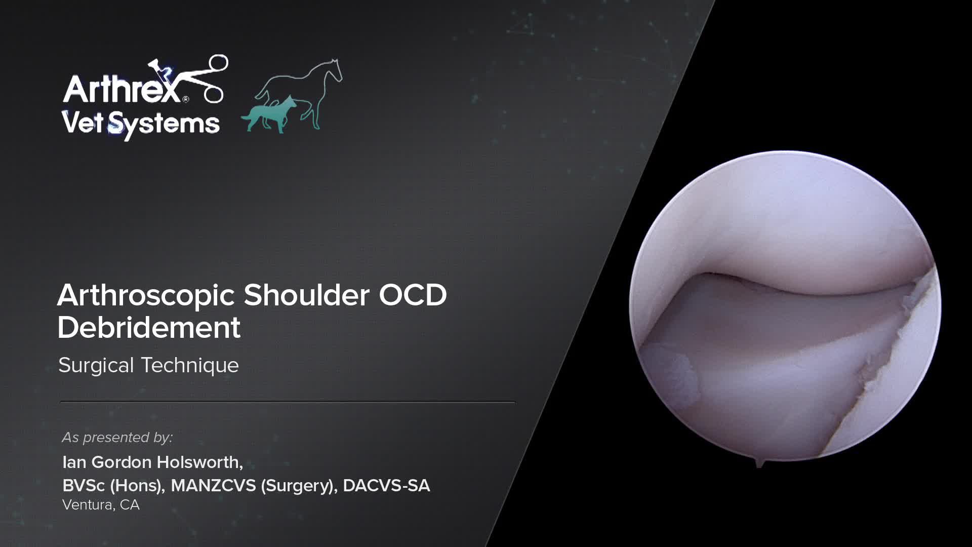 Arthrex Arthroscopic Shoulder OCD Debridement