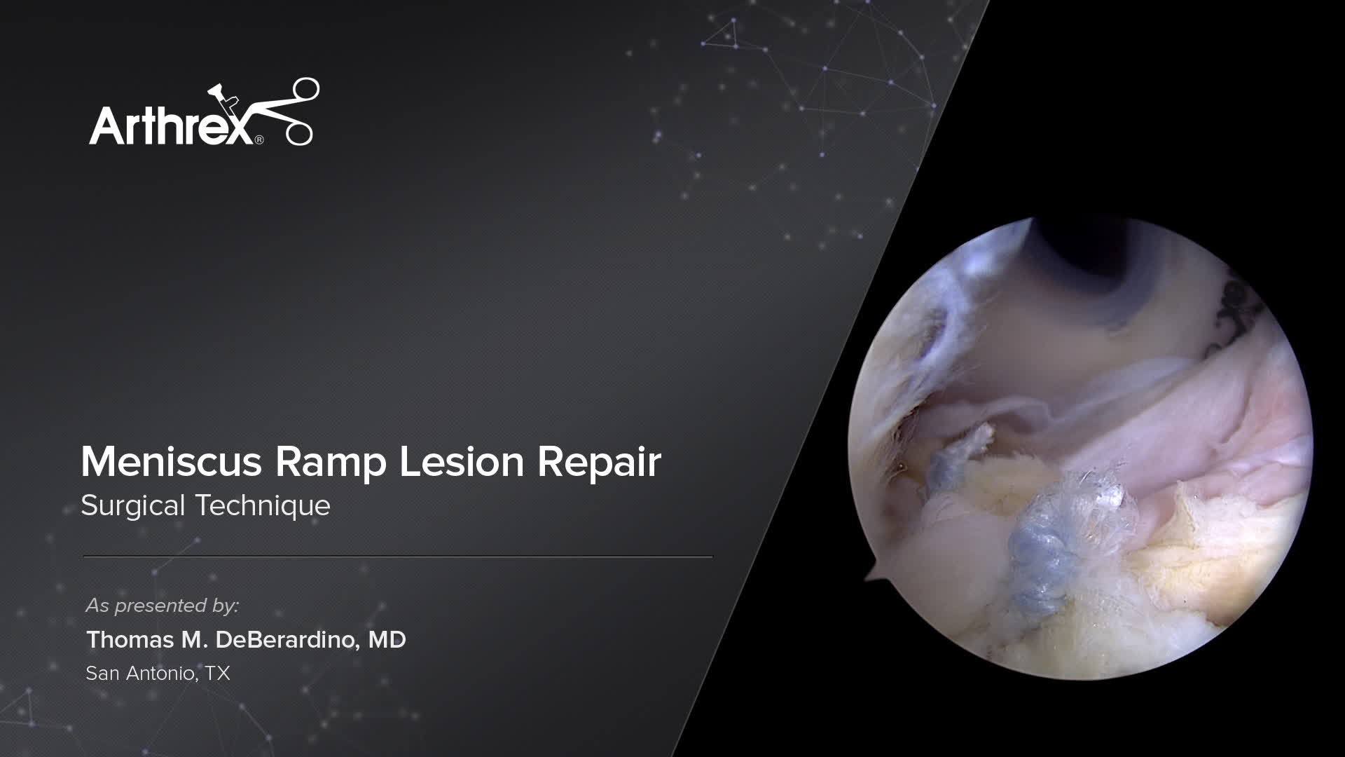 Arthrex Meniscus Ramp Lesion Repair