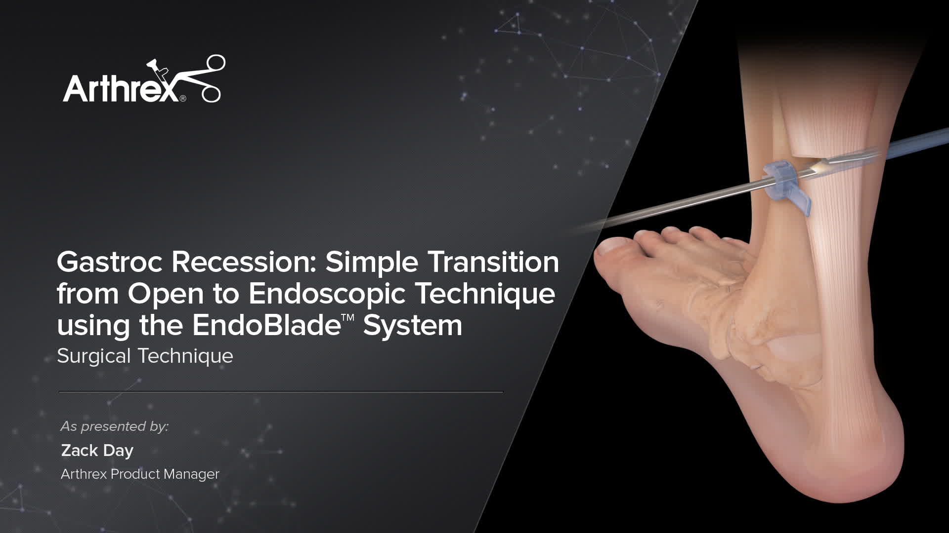 Arthrex Gastroc Recession Simple Transition from Open to Endoscopic