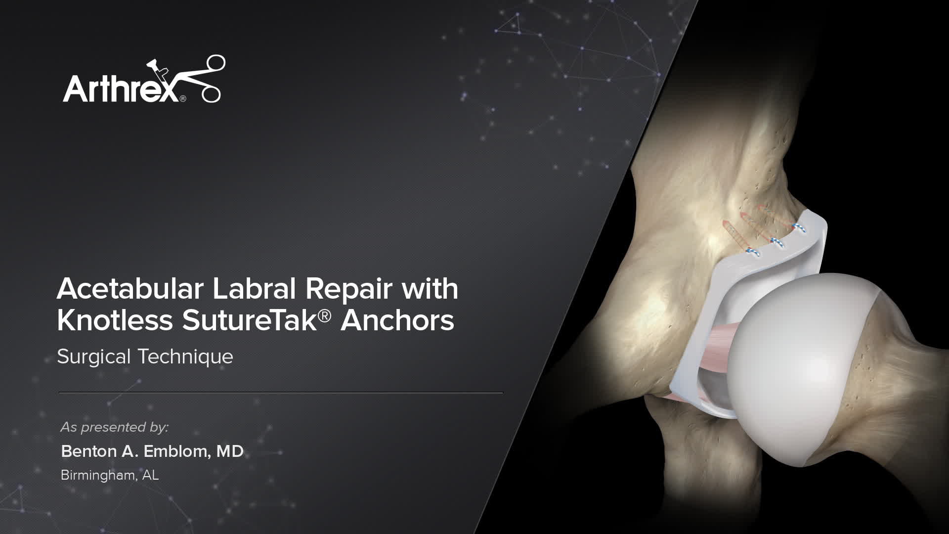 Arthrex Acetabular Labral Repair with Knotless SutureTak® Anchors