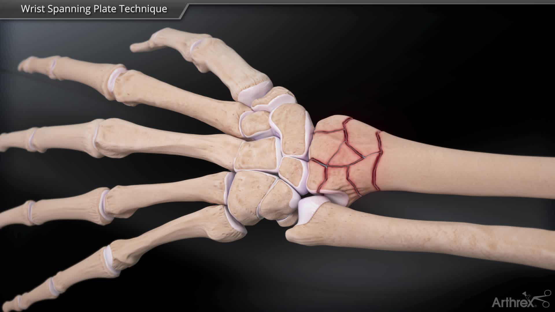 Arthrex Wrist Spanning Plate Technique