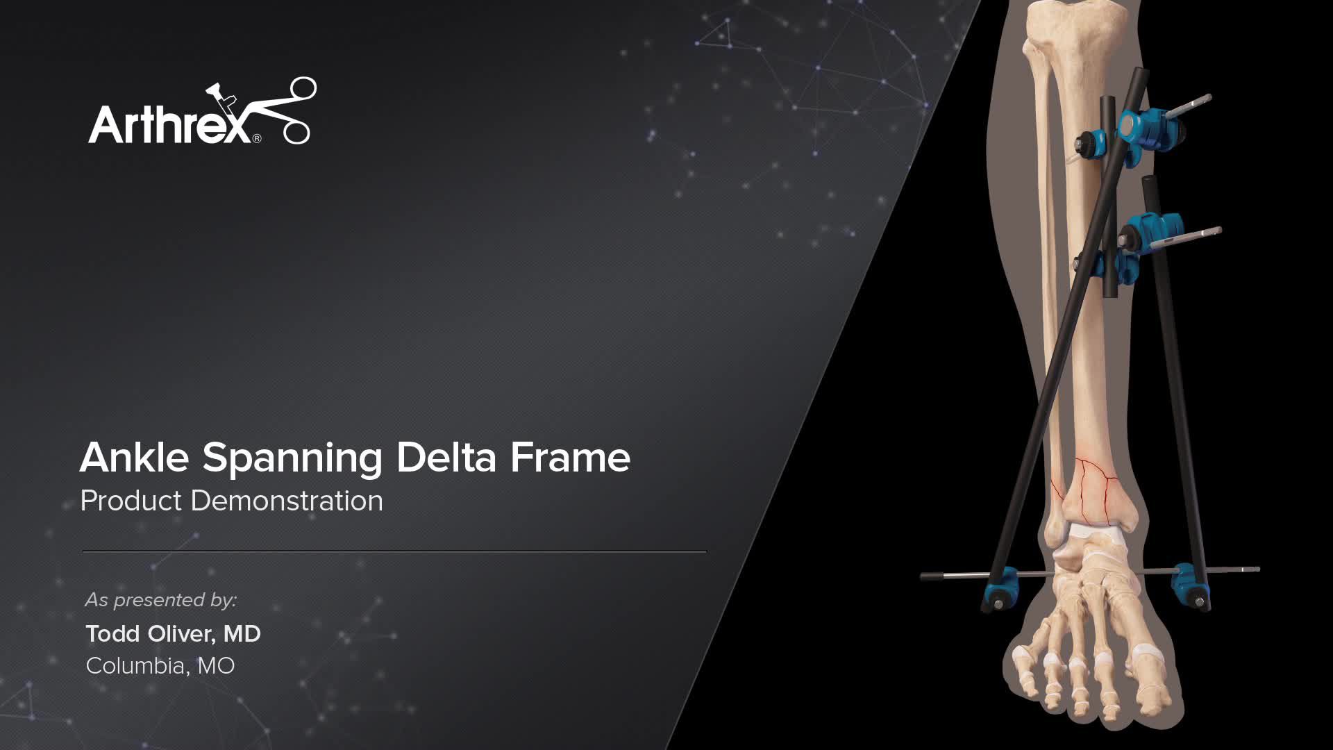 Arthrex Ankle Spanning Delta Frame