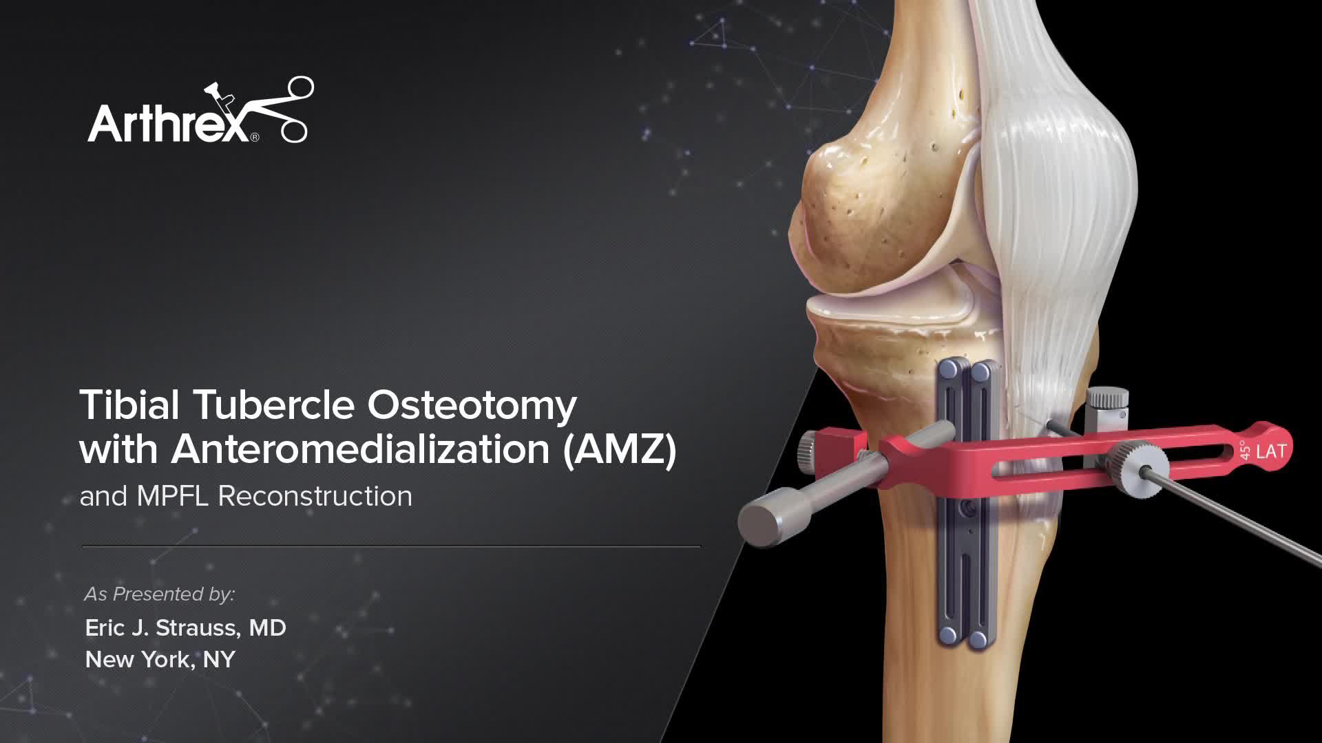 Tibial Tubercle Osteotomy Recovery Time UKVY
