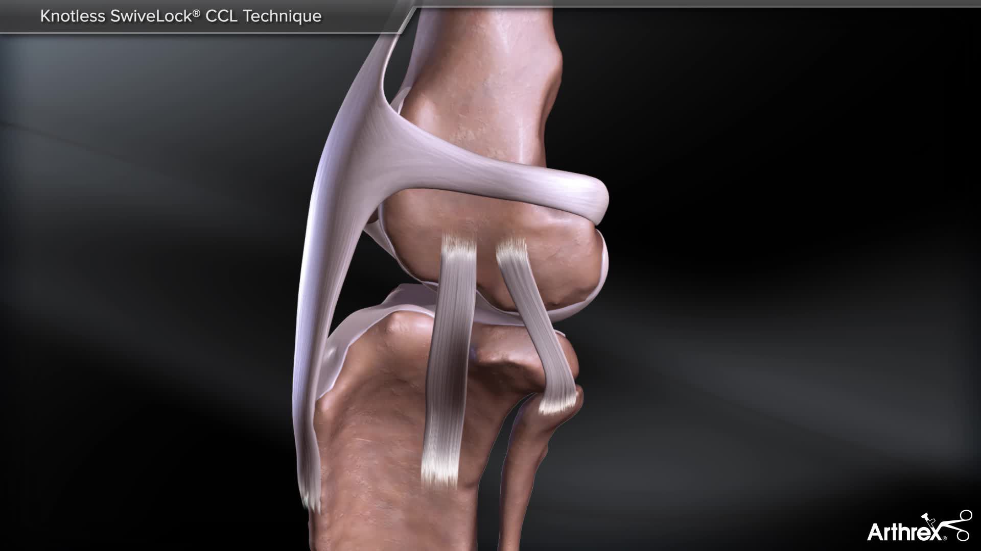 Arthrex Knotless SwiveLock® CCL Technique