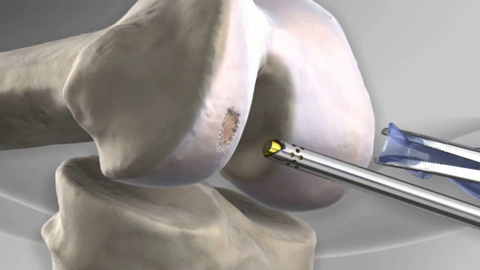 Microfracture Surgery For Cartilage Damage – EFDYEQ