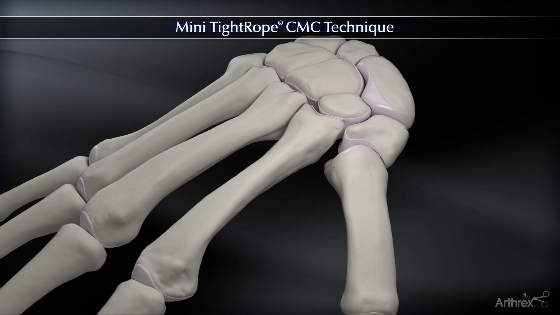 Arthrex Mini TightRope® CMC Technique