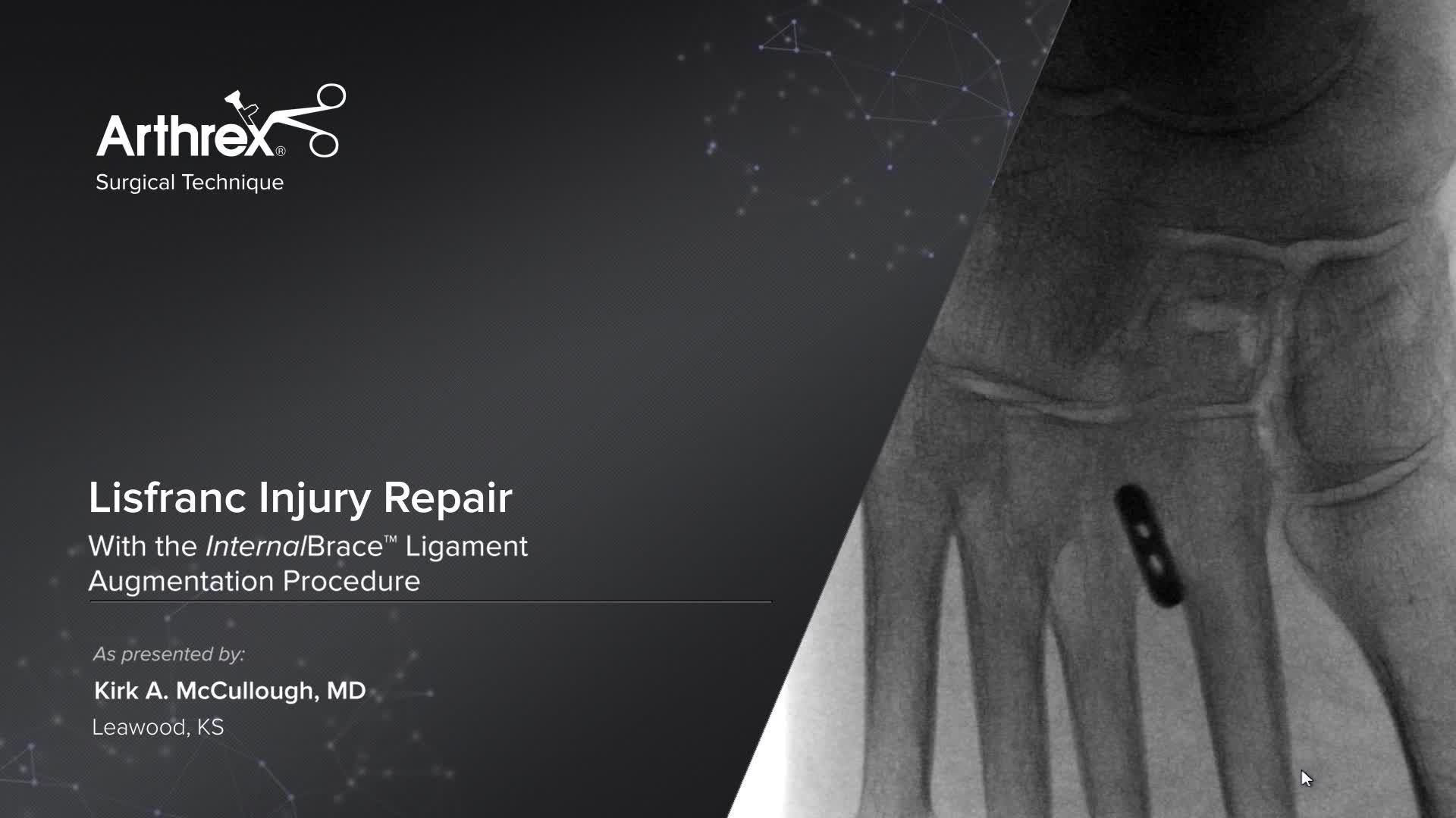 Arthrex Lisfranc Injury Repair With InternalBrace™ Ligament Augmentation