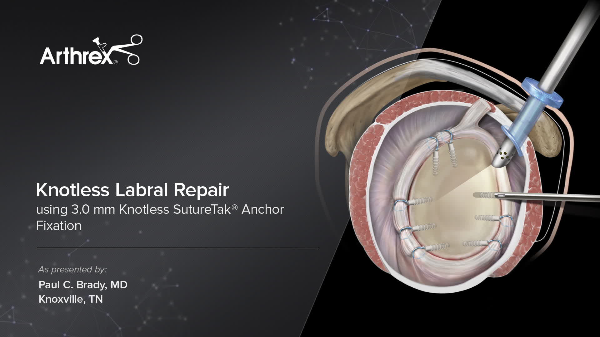 Arthrex Knotless Labral Repair Using 3.0 mm Knotless SutureTak® Anchor Fixation