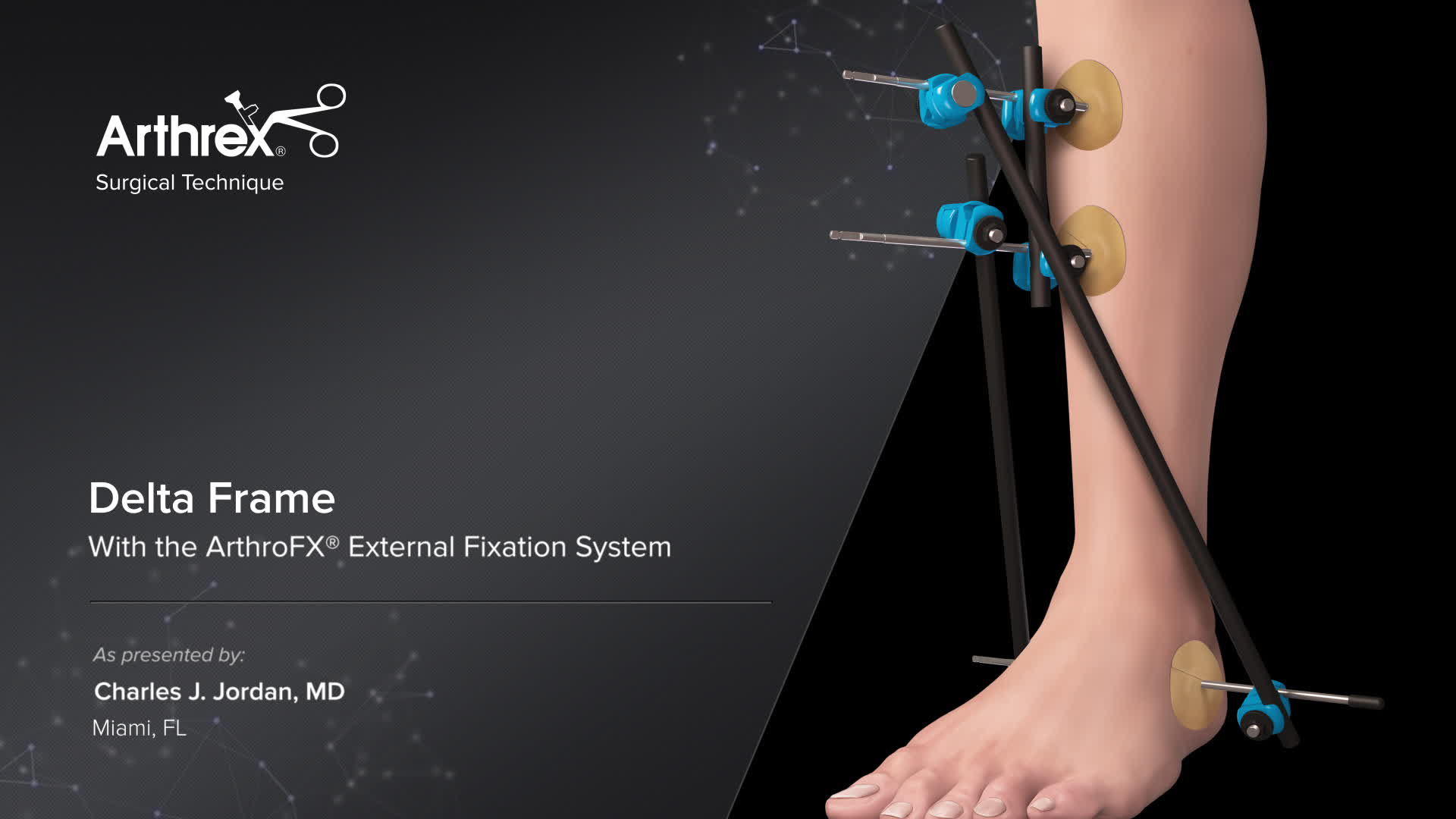 Arthrex Delta Frame With the ArthroFX® External Fixation System