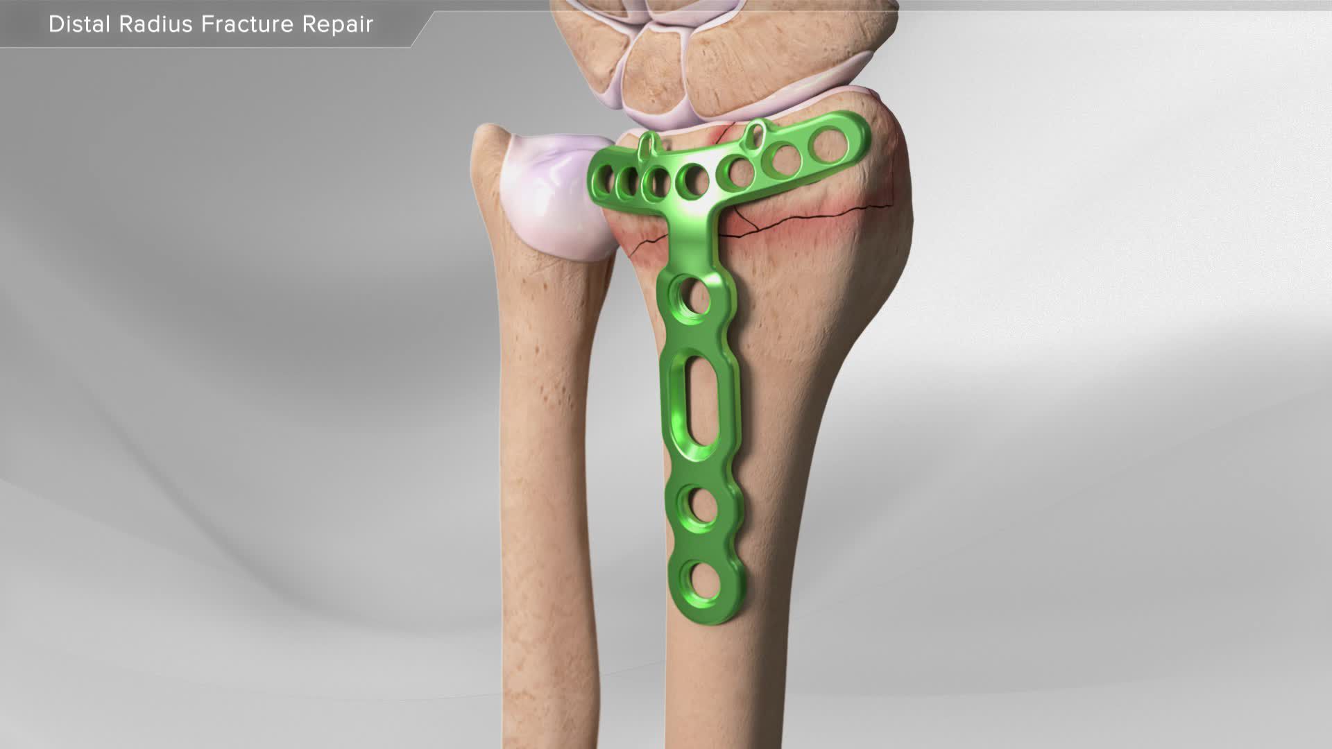 Arthrex Distal Radius Fracture Repair