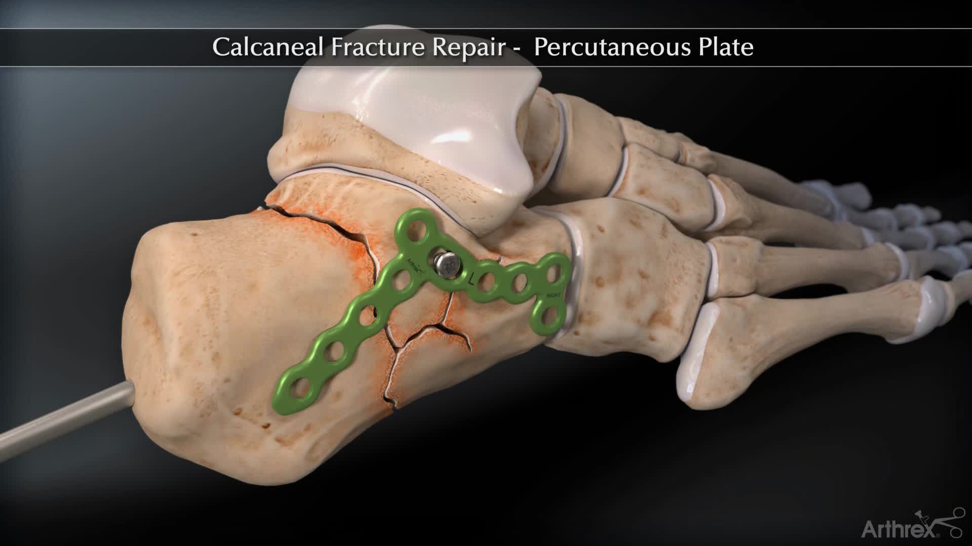 Arthrex Calcaneal Fracture Percutaneous Plate