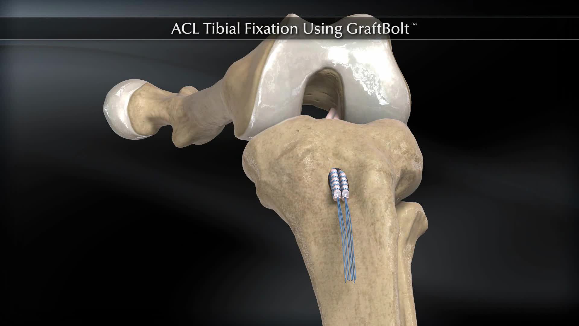 Arthrex ACL Tibial Fixation Using GraftBolt®