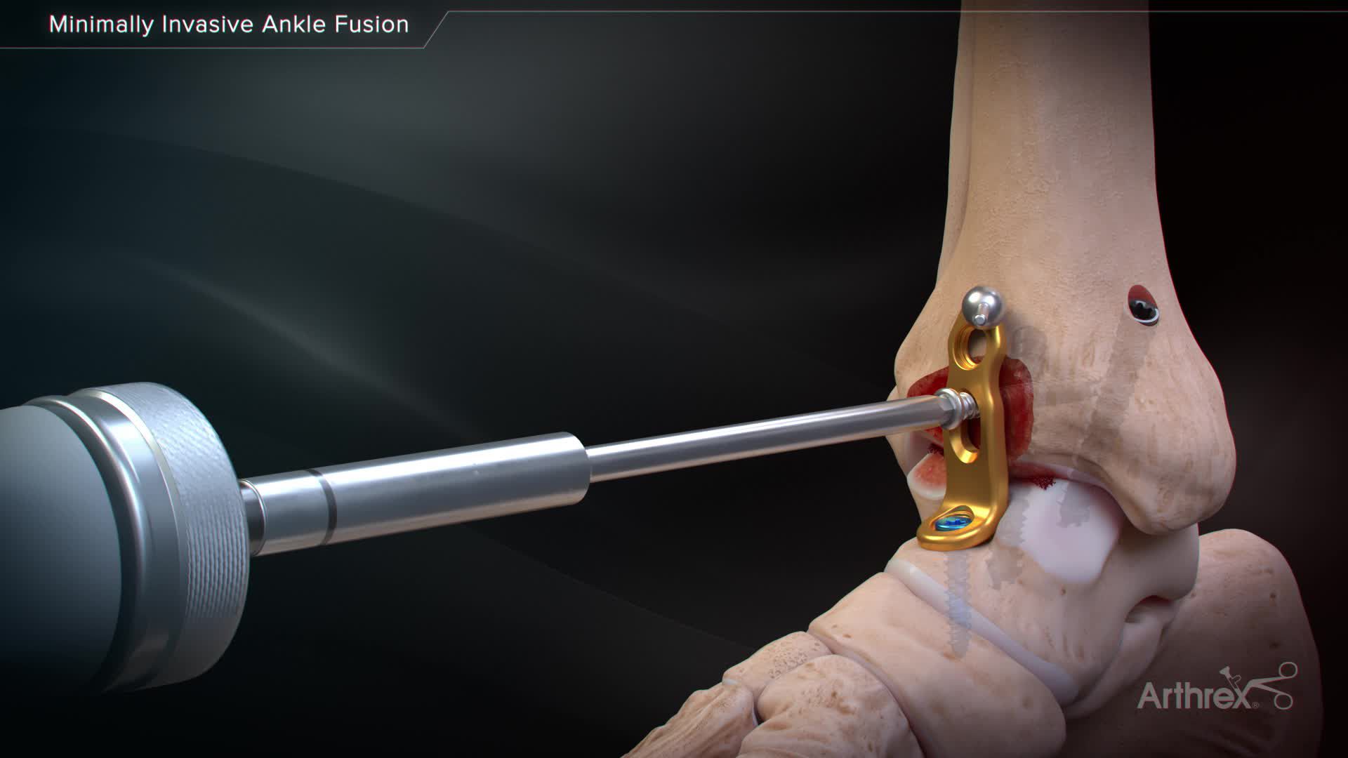 Arthrex Minimally Invasive Ankle Fusion