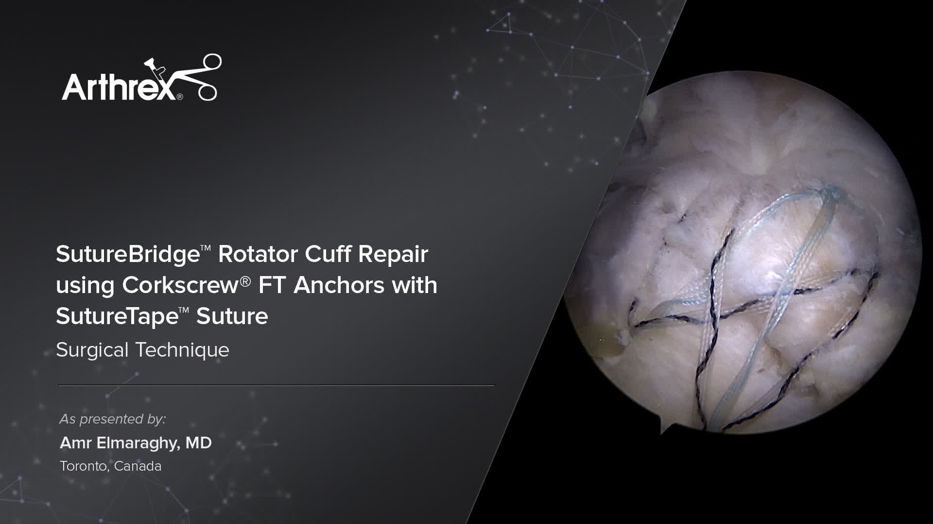 Arthrex SutureBridge™ Rotator Cuff Repair using Corkscrew® FT Anchors