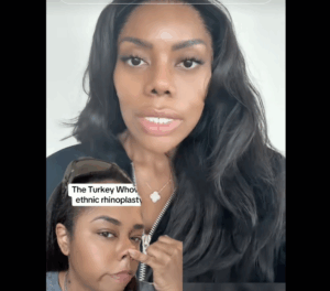 Why The “Ethnic” Nose Job Is The New BBL For Black Women