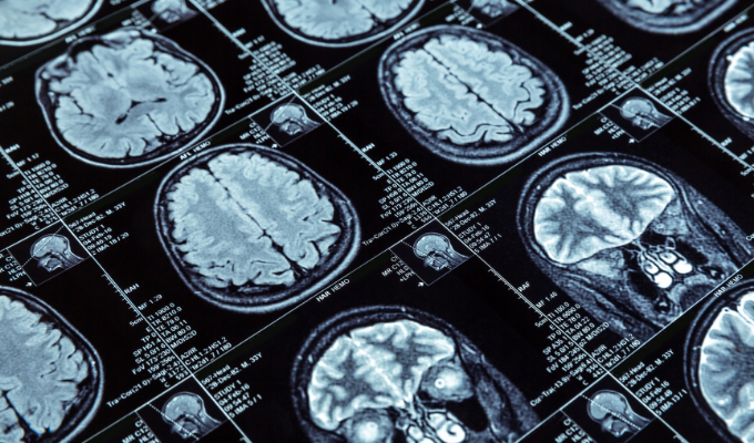 Neuroplasticidade: imagens de uma ressonância magnética do cérebro.