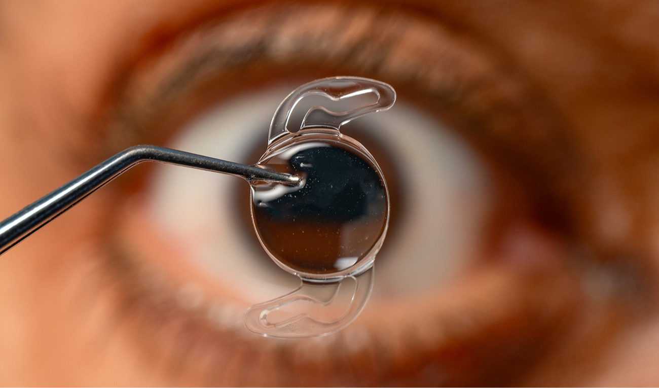 El futuro de la cirugía de cataratas: el implante de lentes intraoculares de última generación permite una visión continua y funcional en todas las distancias. (imagen: Mohammed / Adobe Stock)