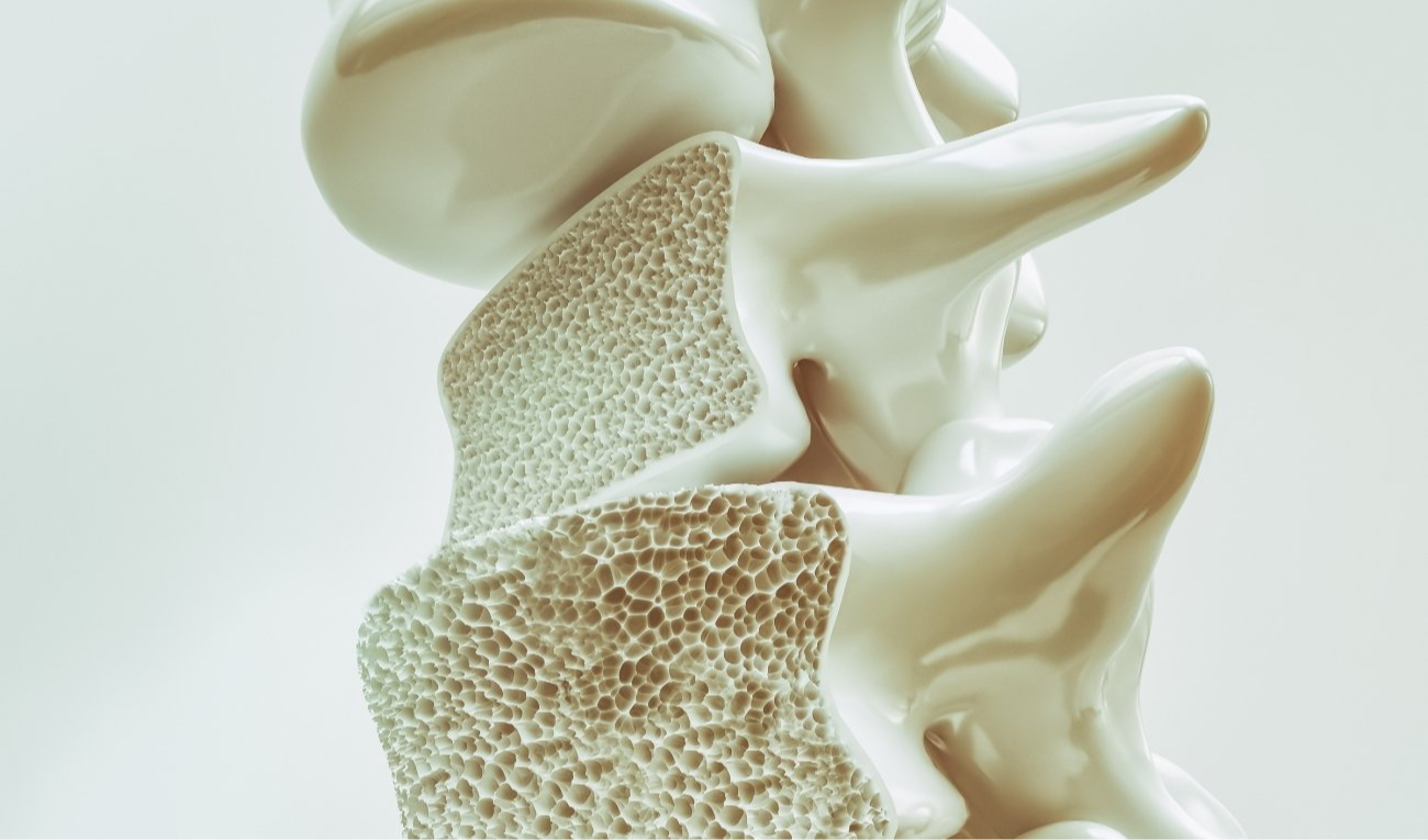 Se está evaluando el uso de fitoestrógenos y extractos de hierbas asiáticas para reequilibrar la remodelación ósea y prevenir las fracturas en la osteoporosis. (imagen: CreVis2 / Getty Images Pro)