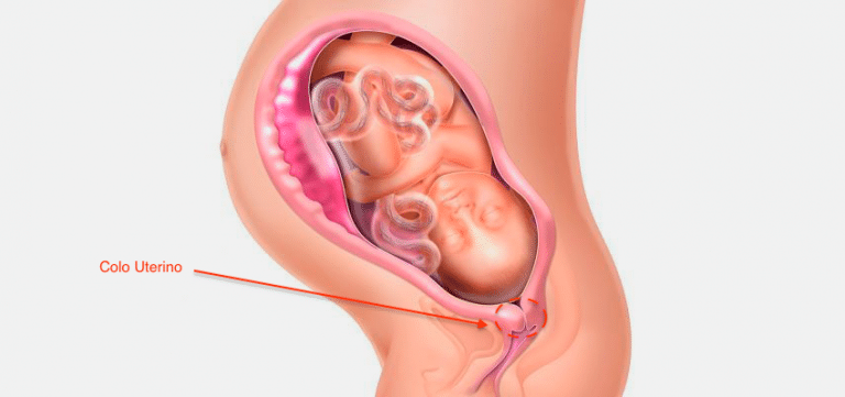 O que é a medida do colo uterino na gravidez? | Fetalmed Medicina Fetal