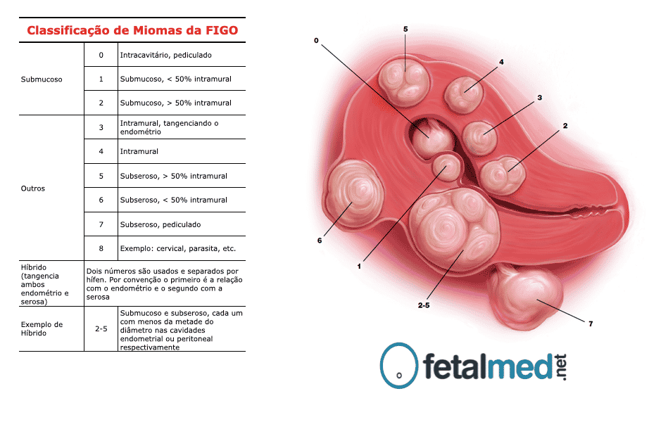 Miomas Uterinos E Gravidez Miomas E Gravidez Poss vel Adriana Miomas Uterinos E Gravidez Miomas E Gravidez Poss vel Adriana