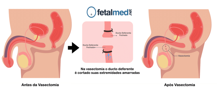 Gravidez após Vasectomia: Desvendando o Inesperado | Fetalmed