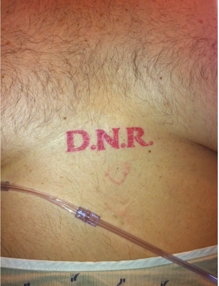 “D.N.R.” tattoo patient received as a result of losing a bet made while intoxicated and playing poker with hospital coworkers. From “DNR Tattoos: A Cautionary Tale” in the Journal of General Internal Medicine.