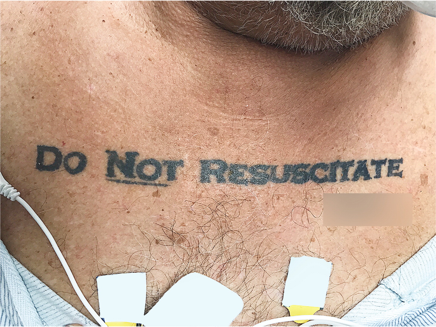 Unconscious patient with a DNR tattoo