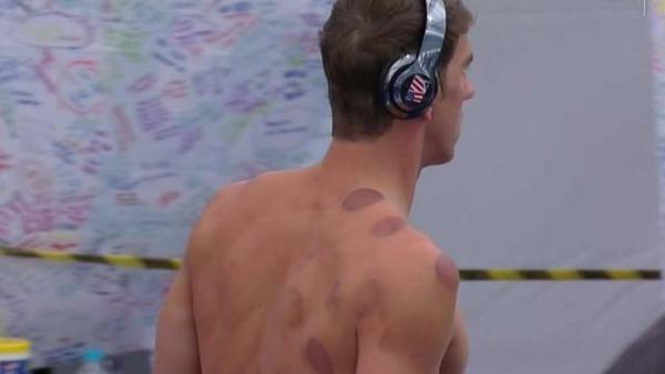 Cupping