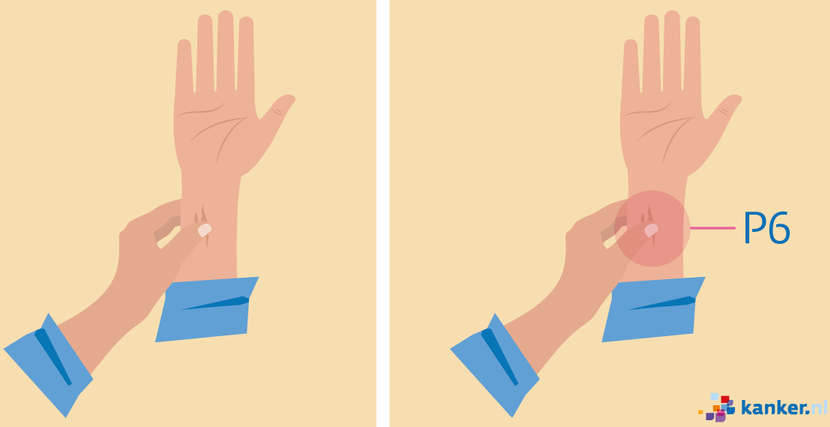 Acupressuur bij misselijkheid