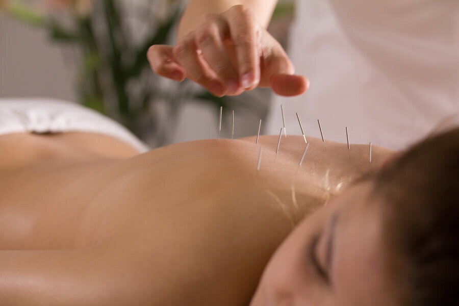 No more back pain thanks to acupuncture