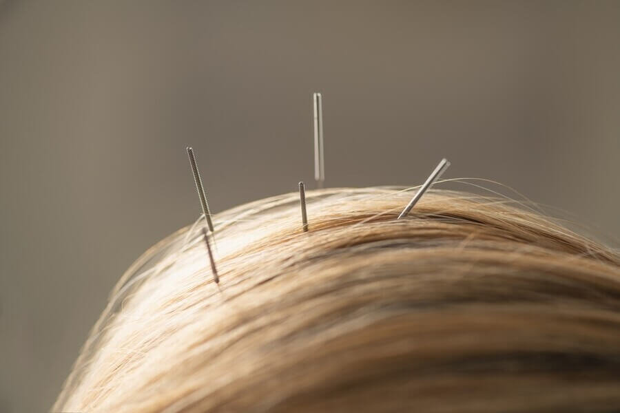 De gereedschapskist van de acupuncturist - Frank Ettema over Japanse schedelacupunctuur