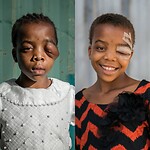 voor-na foto van een hier veel voorkomende huidafwijking in het aangezicht