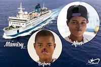 Voor-na foto van een correctie van het aangezicht na een infectie