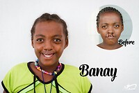 Voor-na foto van een hazenlip correctie