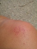 board rash