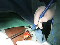de 1e operatie is een varicocele bij een man met een kinderwens