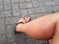 Zonne-allergie, dit is maar een klein stukje....
