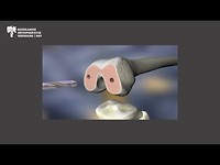 Animatie: plaatsen totale knieprothese