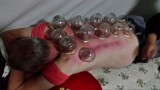 Cupping. Ying en yang