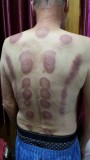 Cupping. Ying en yang