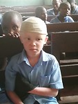 Boy with Albinisme.