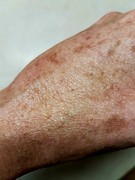Spiderbite in October