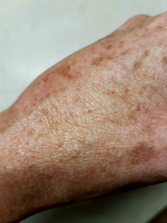 Spiderbite in October