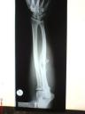 X-ray onder arm