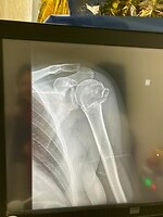 op meerdere plekken gebroken