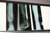 Gebroken been met externe fixateur die nog voor verbetering vatbaar is.