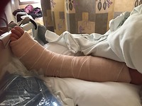 surgery went well, a rod in the shin.