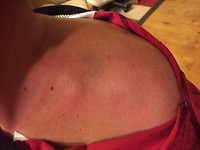 broken collarbone