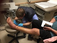 removing stitches
