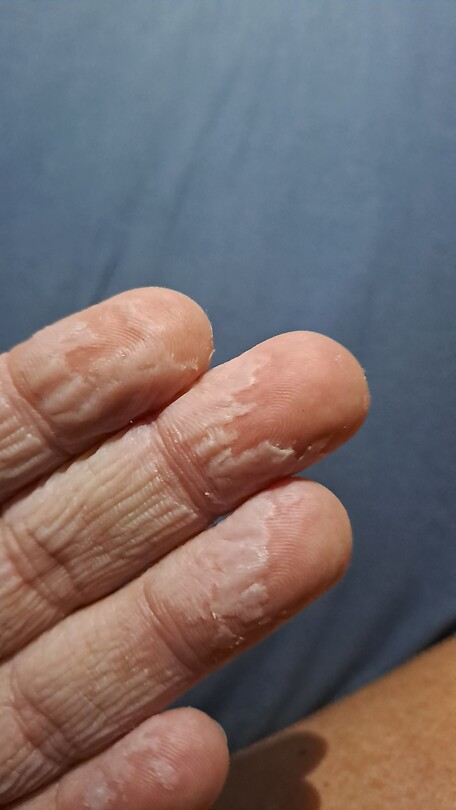 Afgeb(l)adderde vingers